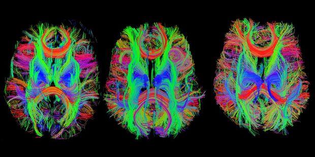 Un nuevo método puede recuperar la memoria de los enfermos de Alzheimer